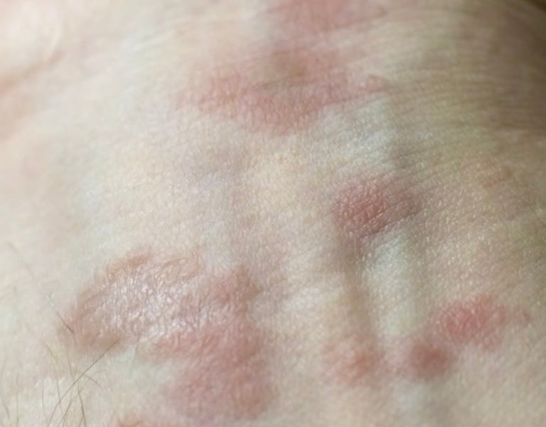 Eczema Essentials: A Comprehensive Guide to Eczema Skincare